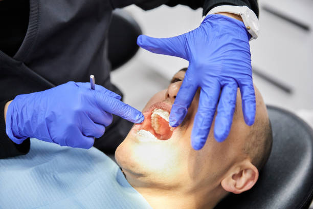 Best Emergency Wisdom Tooth Extraction in Euclid, OH